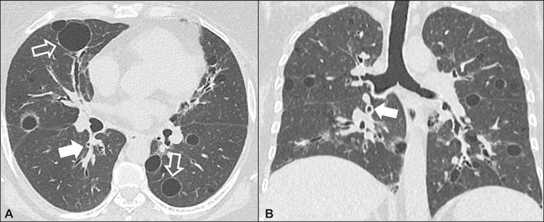 A CT scan image of human lungs and chest